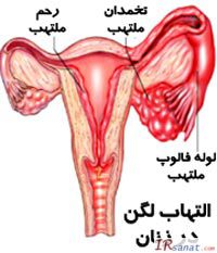 بیماری التهاب لگن,علت بیماری التهاب لگن در زنان,درمان بیماری التهاب لگن