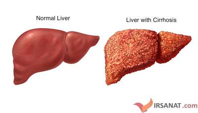 نارسایی کبدی,علائم بیماریهای کبد,پیشگیری از بیماریهای کبدی