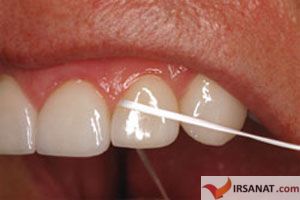 استفاده از نخ دندان,کشیدن نخ دندان,جایگزین نخ دندان