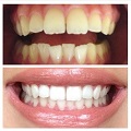 آشنایی با روش های سفید کردن دندان