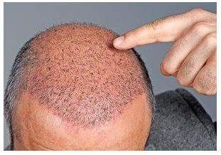 کاشت مو چه عوارضی دارد؟