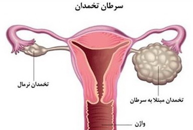 نشانه‌های ظریف سرطان تخمدان که شاید نادیده گرفته شوند