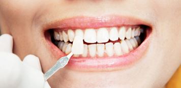 لمینت دندان چیست, معایب لمینت دندان