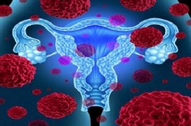 سندروم تخمدان پلی کیستیک برای زنان میانسال مشکل ساز است