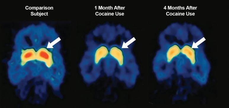 چه اتفاقی در مغز مصرف کنندگان مواد مخدر می افتد ؟