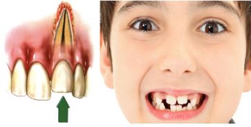 مراحل پوسیدگی دندان, مرگ در مغز دندان