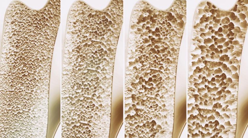 کشف مکانیسم جدید برای رشد استخوان های مستحكم برای درمان آینده پوکی استخوان