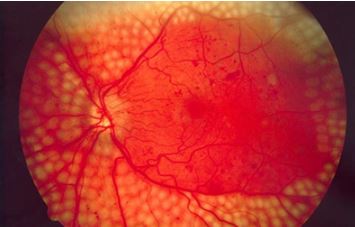 یک چربی موثر در پیشگیری از ابتلا به بیماری چشم دیابتیک کشف شد