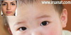 تشخیص کمبود ویتامین بدن نوزادان با اشک چشم به جای خون‌گیری